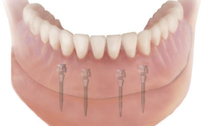 Implant Anchored Dentures