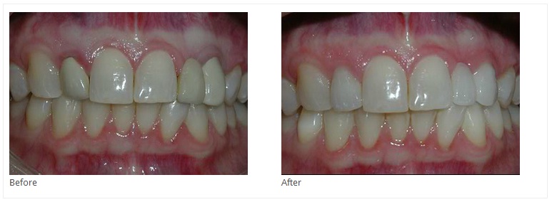 45 Year Old Female was Very Unhappy with Her Smile
