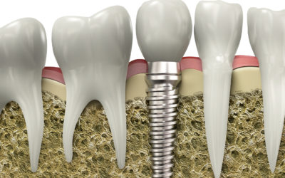 Dental Implants: What is an implant?