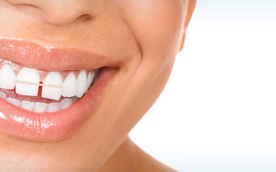 Diastemas: Closing Spaces Between Teeth